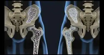Какова роль различных бисфосфонатов в профилактике остеопороза?