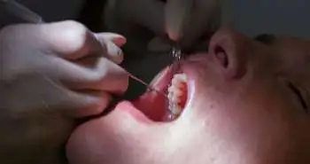 New dental procedure brings a breakthrough in the management of small teeth cavities