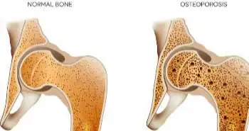 Up-to-date guidelines for the prevention and treatment of osteoporosis