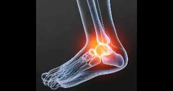 Perioperative factors found to influence the development of pain after ankle surgeries for osteoarthritis