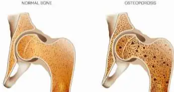 Effect of bisphosphonate drug holidays on bone mineral density (BMD) and osteoporotic fracture risk