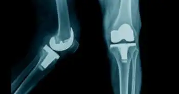 Patellofemoral arthroplasty (PFA) or total knee arthroplasty (TKA); which therapy is related to more return to the operating room?