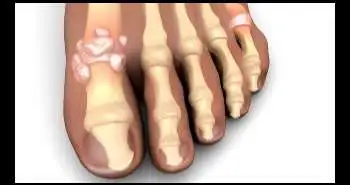 Canakinumab for gouty arthritis