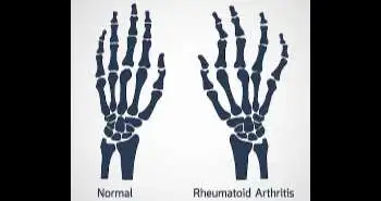 Biologic treatment in comparison to Methotrexate has positive effect on trabecular bone score in rheumatoid arthritis (RA) patients