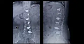 Application of cement-injectable cannulated pedicle screw for the osteoporotic thoracolumbar vertebral compression fracture (AO Type A) treatment