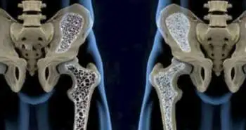 Type 2 diabetes increases the risk of fragility fractures