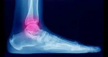 Bone density correlates with clinical outcomes after ankle fracture fixation