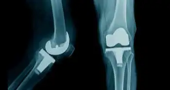 Do's and don'ts in osteoarthritis