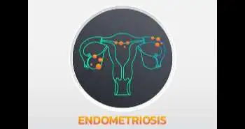 Laparoscopic Hysteropexy found effective in correcting uterine retrodisplacement, temporarily