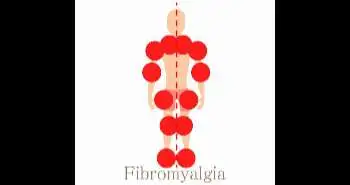 Safety and efficacy of CR-Pregabalin found to be similar to IR-Pregabalin in fibromyalgia