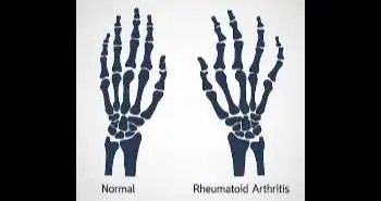 The new formulation of Adalimumab showed more promising treatment outcomes in Rheumatoid Arthritis patients