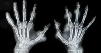 Adalimumab and related biosimilars for rheumatoid arthritis management: A review