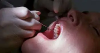 Coaxial superelastic nickel-titanium (NiTi) archwires found efficient in orthodontic treatment