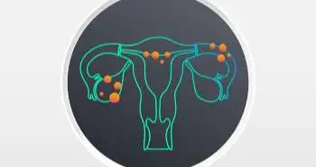 Relationship of serum caspase-3 levels with endometriosis severity
