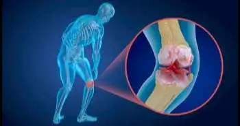 Mesenchymal Stem Cells injection found to be effective for management of knee osteoarthritis
