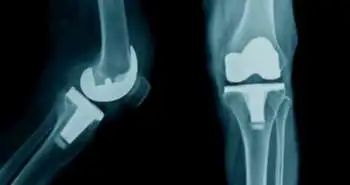 Interimplant fractures found to be predominant in elderly women, osteoporosis could be a significant risk factor