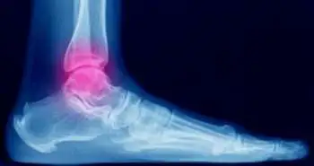 A study to estimate clinical and radiological outcomes of Transfibular Total Ankle Replacement