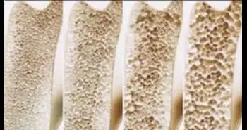Romosozumab, a dual action drug found effective in osteoporosis management