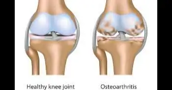 AASK: A tool to validate symptom outcome for knee OA