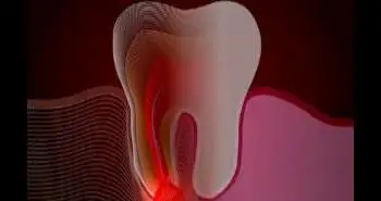 Oral Prednisolone found to be effective in the treatment of postoperative endodontic pain