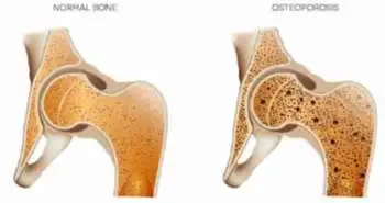 Advances in controlled drug delivery for treatment of osteoporosis