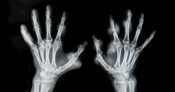 Abatacept found effective for RA patients as assessed by MRI of bilateral hands