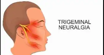 Triggers can help diagnosing trigeminal neuralgia