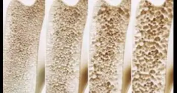 Denosumab treatment for 10 years found safe in postmenopausal women with osteoporosis