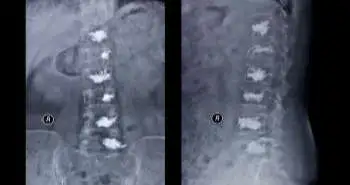 Comparative analysis of the radiolographs of osteoporotic vertebral fractures in men and women