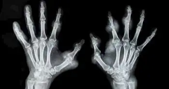 Decrease in bone mineral density during three months after diagnosis of early rheumatoid arthritis measured by digital X-ray radiogrammetry predicts radiographic joint damage after one year