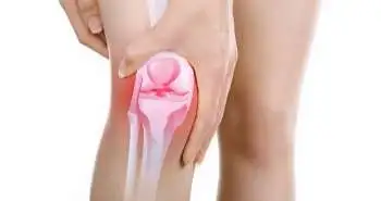 Risk factors for joint replacement in knee osteoarthritis; a 15-year follow-up study