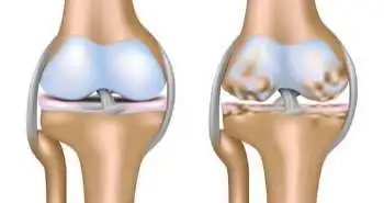 Effect of bisphosphonates on knee replacement surgery