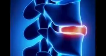 Limaprost or Pregabalin: Preoperative and postoperative medication for pain due to lumbar spinal stenosis
