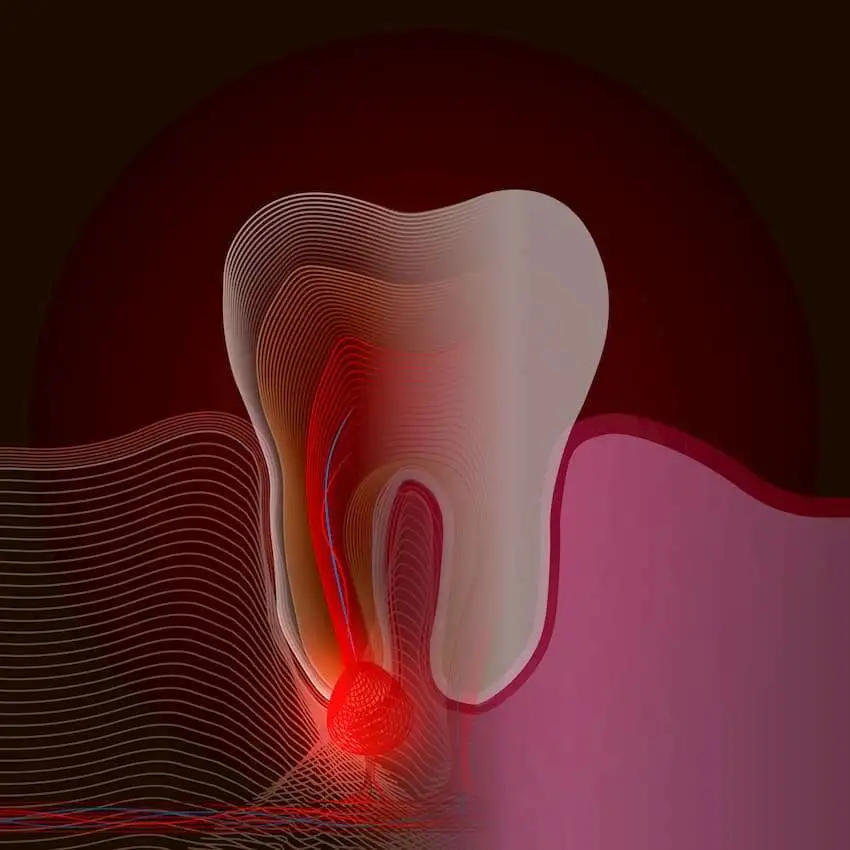Combination analgesics can reduce postoperative pain related to irreversible pulpitis of teeth