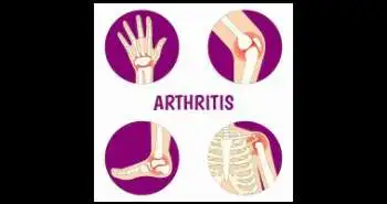 Inflammatory arthritis in pediatric patients with morphea