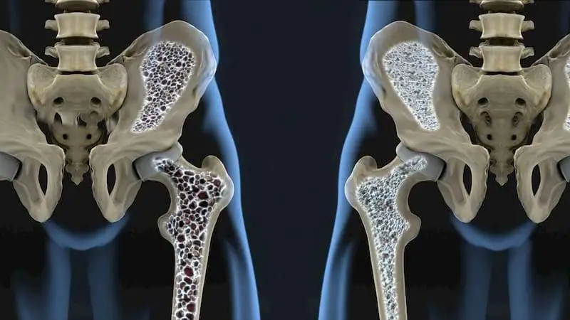 Паратиреоидный гормон и аналоги на основе родственных ему белков можно эффективно применять для лечения остеопороза