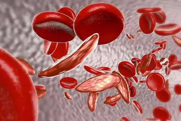 Пероральный L-глютамин эффективно справляется с болью при серповидноклеточной анемии