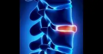 New screening tool found for predicting spinal OP