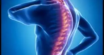 Spinal pain found to be a common occurrence in AIS