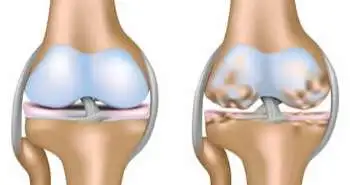 Liposomal bupivacaine for pain control after anterior cruciate ligament reconstruction