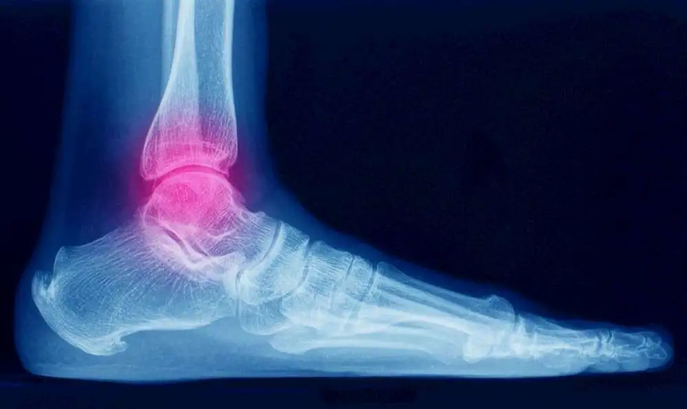 Factors concerned with pain intensity and physical limitations after lateral ankle sprains