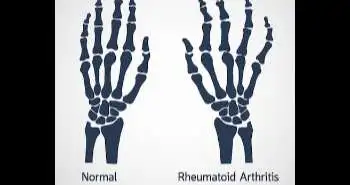 What exactly is living with persistent rheumatoid arthritis: a BARFOT study?
