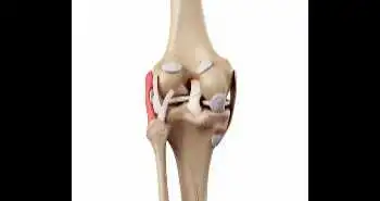 Эндопротезирование коленного сустава с использованием подвижной и фиксированной платформы при остеоартрозе коленного сустава в одном отделе имеет схожую эффективность