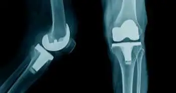 Исследование по оценке эффективности одномыщелкового эндопротезирования латерального отдела коленного сустава при остеоартрозе коленного сустава