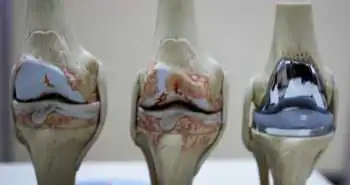Study evaluates targeting of rehabilitation to improve total knee arthroplasty outcomes