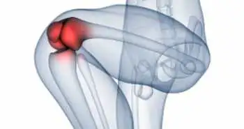 Study evaluates safety and efficacy of topical nimesulide to treat knee osteoarthritis