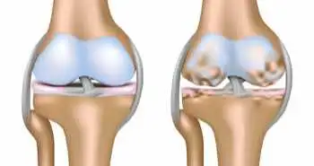 Метод непрерывной ультразвуковой терапии в комбинации с диклофенаком способствует снижению выраженности симптомов остеоартроза коленного сустава