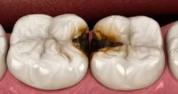Self-assembling peptide therapy found effective to remineralize enamel caries