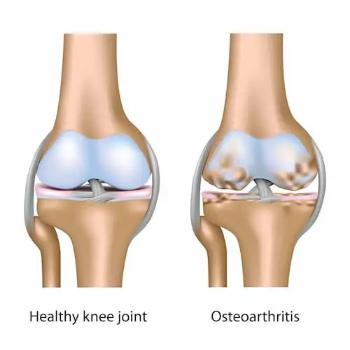knee.osteoarthritis