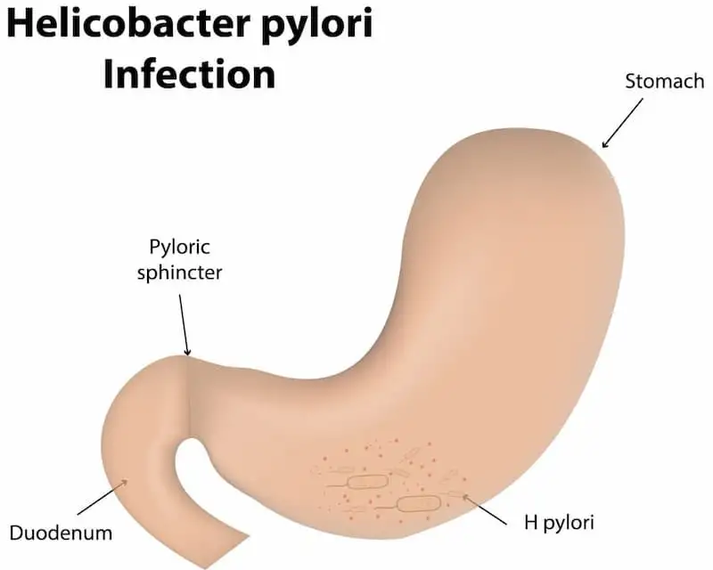Helicobacter.pylori